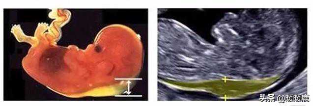三分钟看懂孕期B超检查单的专业术语，判断胎儿是否畸形